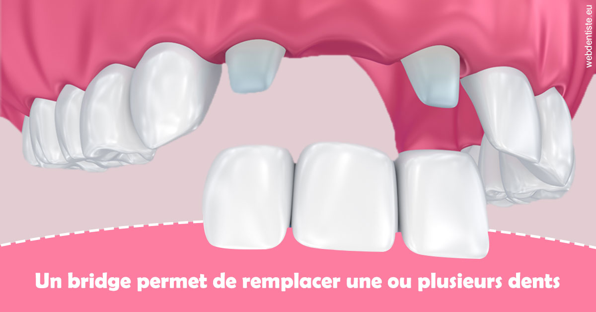 https://www.hygident-oceanis.fr/Bridge remplacer dents 2