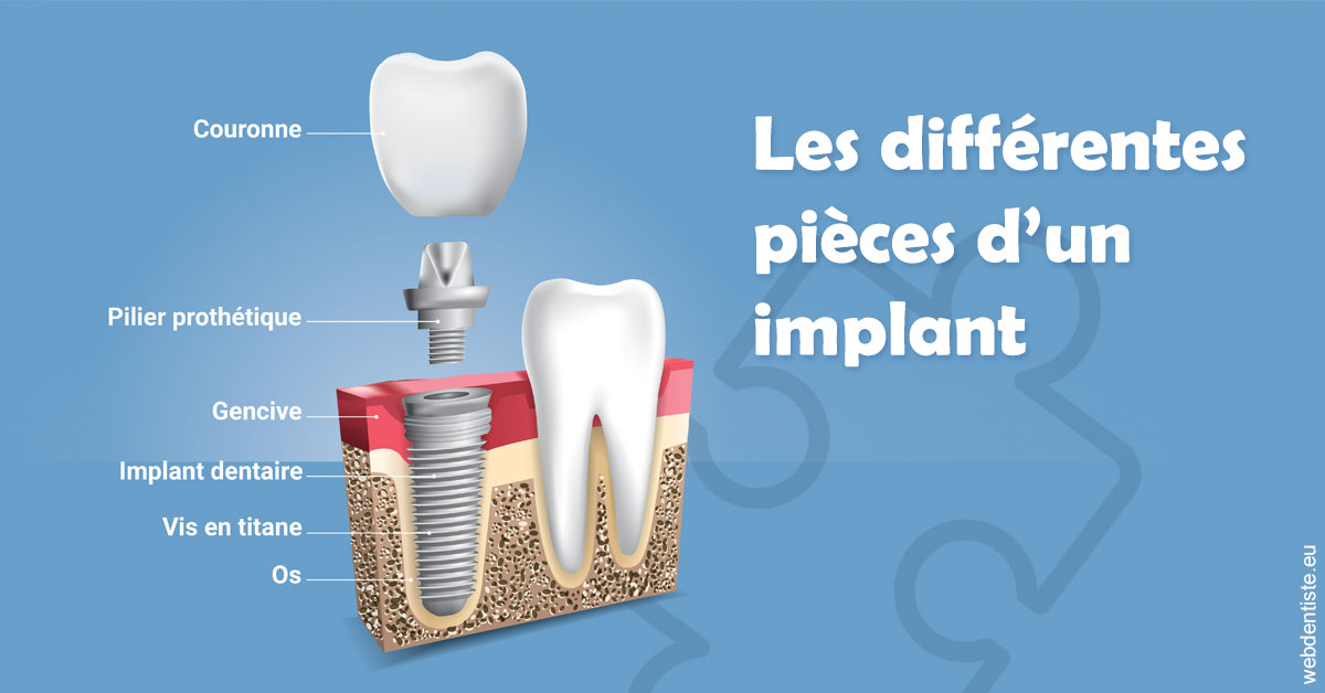 https://www.hygident-oceanis.fr/Les différentes pièces d’un implant 1